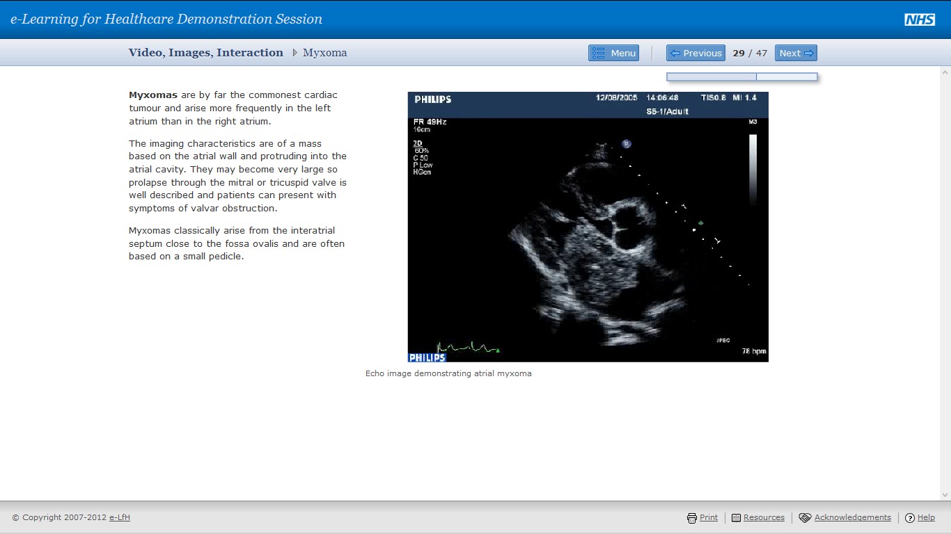 Myxoma screen with explanatory text and ultrasound image labelled atrial myxoma.
